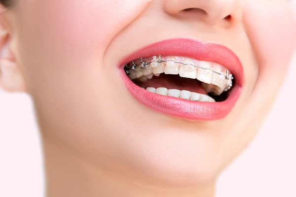 Clear Braces: What Foods Should You Avoid?