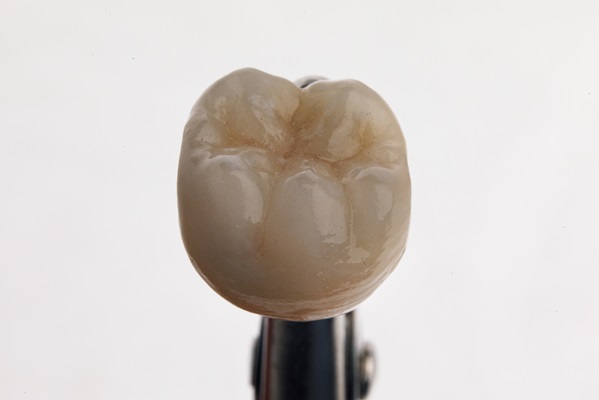 When A Dental Crown May Need To Be Replaced