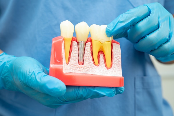 Bone Grafting For Dental Implant Placement