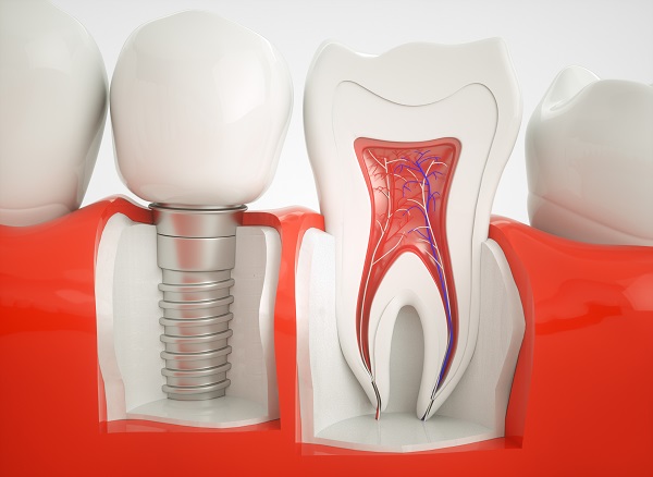Health Benefits Of Dental Implants For Your Jawbone