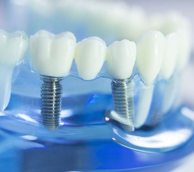 Atlanta Dental Implants