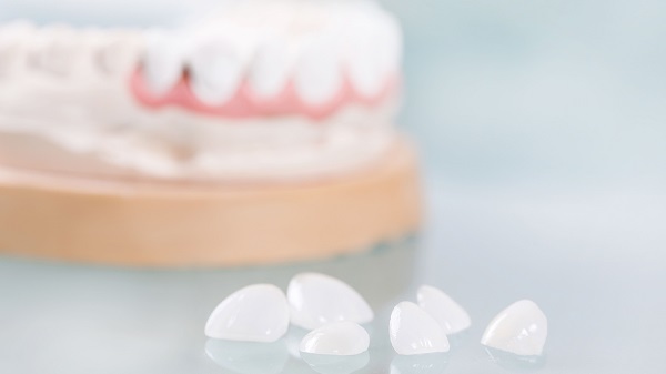 What Are Options With Dental Veneers?