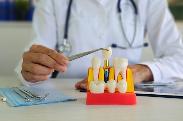 Implant Overdentures From An Implant Dentist