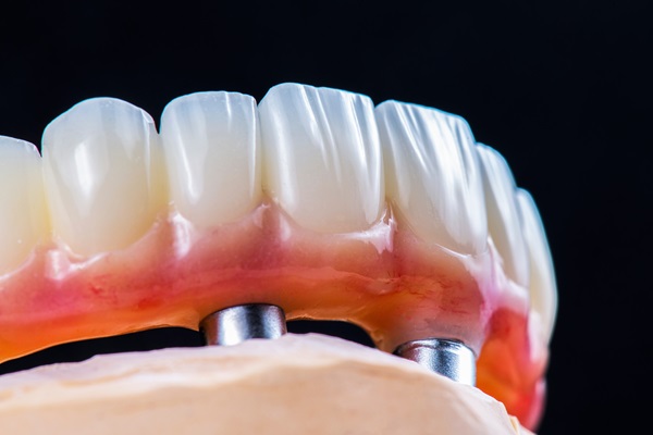 Bring Back A Stronger Smile With Implant Supported Dentures