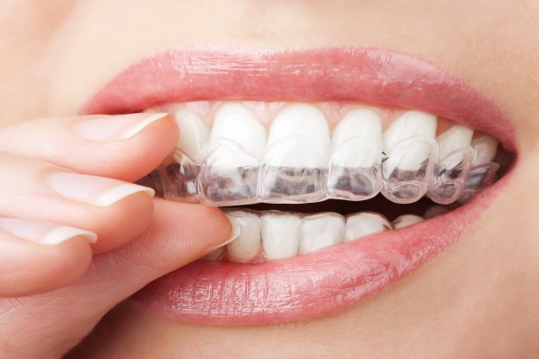 Invisalign: Invisible Orthodontics For Teeth Straightening